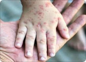 آبله‌مرغان در بزرگسالان؛ بیماری شدیدتر و عوارض خطرناک‌تر از کودکان