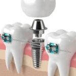 ارتودنسی برای ایجاد فضای مناسب ایمپلنت دیجیتال