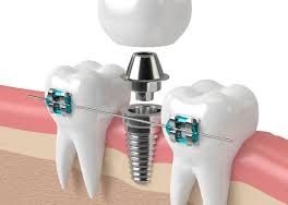 ارتودنسی برای ایجاد فضای مناسب ایمپلنت دیجیتال