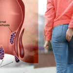 درمان قطعی بواسیر با لیزر؛ پایان دردهای همیشگی در بیماری های نشیمنگاهی.