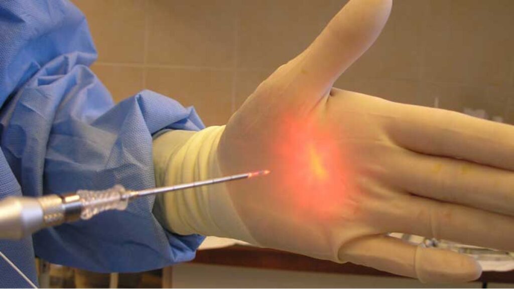 لیزر هموروئید؛ درمانی قطعی و فوری